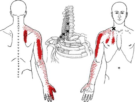 icd 10 for myofascial pain